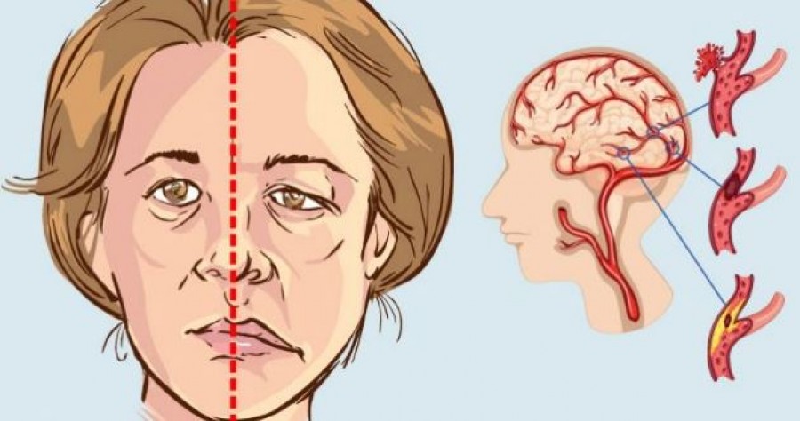 Kevesen tudják, hogy ezek növelik a stroke kialakulásának esélyét